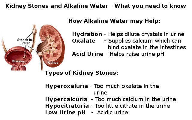 alkaline water kidney stone infographic