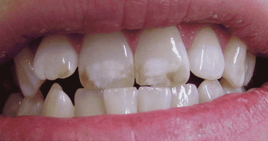 dental fluorosis image